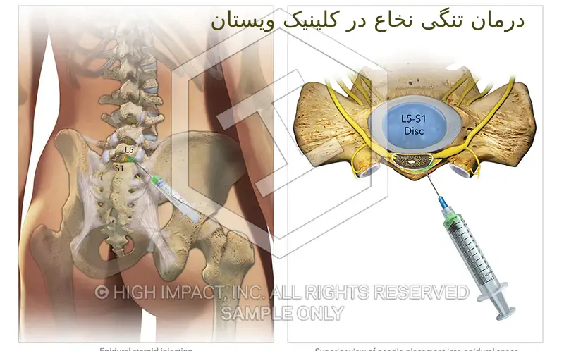 بیمار باید از مزایا و معایب این روش آگاه باشد. درمان تنگی نخاع تاریخچه پزشکی بیمار بررسی میشود.