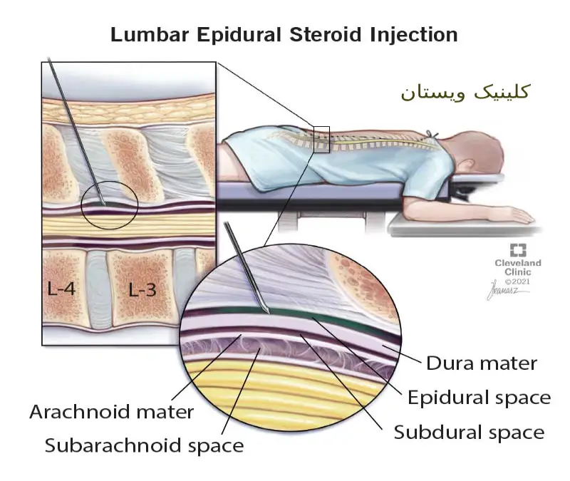 داروی بیحسکننده موضعی به ناحیه تزریق میشود. تزریق اپیدورال به صورت سرپایی انجام میشود