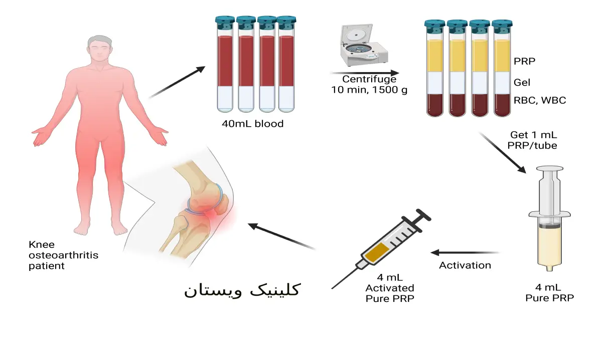بهترین دکتر پی ار پی زانو در تهران و هزینه پی ار پی با بیمه