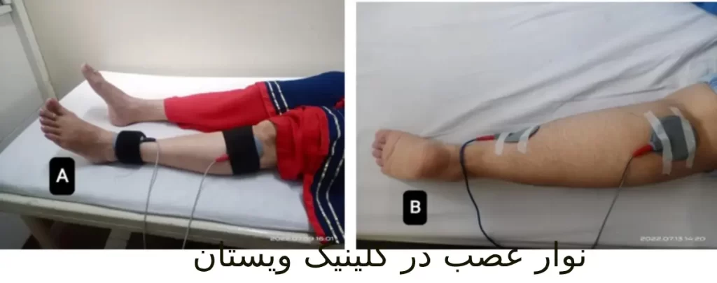 نوار عصب و عضله به تشخیص مشکلات حرکتی کمک میکند. انجام نوار عصب پا در کلینیک ویستان