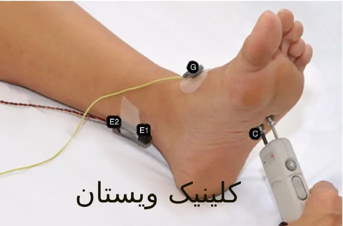 نوار عصب و عضله میتواند نشانههای بیماریهای جدی را نمایان کند. انجام نوار عصب کف پا