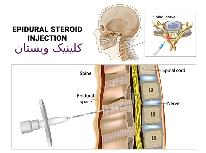 روشهای غیرجراحی دیگر نیز وجود دارند انتخاب این روش بستگی به وضعیت بیمار دارد.
