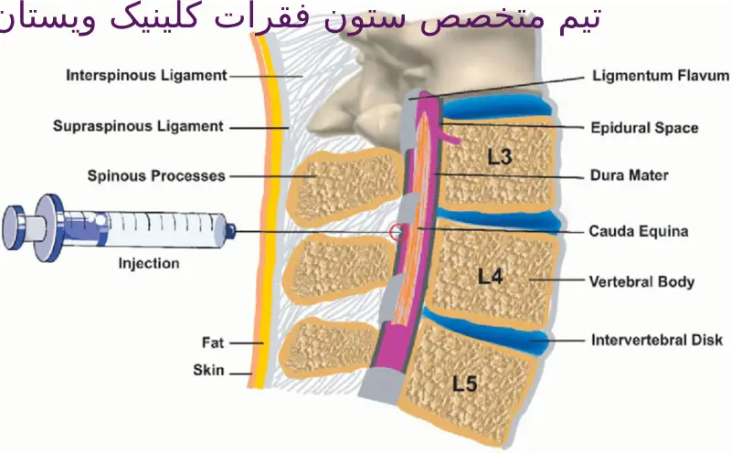 تزریق اپیدورال میتواند کیفیت زندگی را بهبود بخشد. پیگیریهای منظم برای ارزیابی بهبودی لازم است