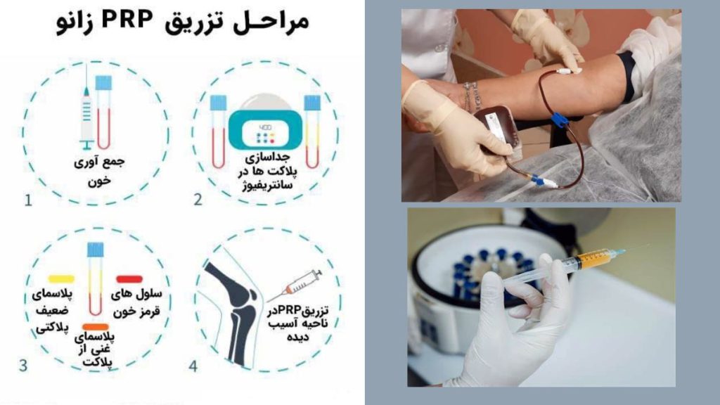 مراحل تزریق 4 مرحله تزریق پی ار پی