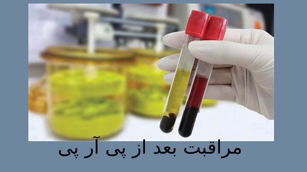 بهبودی پس از تزریق کیت پی آر پی که اماده برای تزریق است