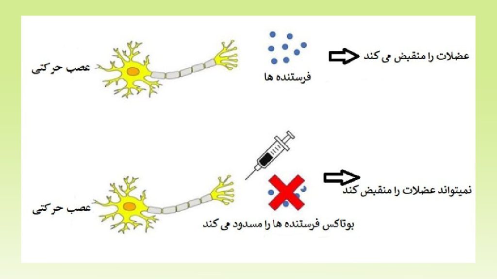 درمان میگرن مزمن با بوتاکس مراحل و روند درمانی بوتاکس روی سردردهای میگرنی