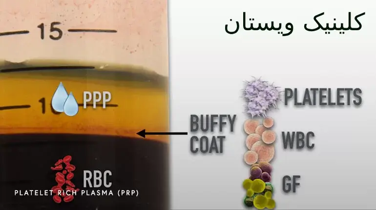 درمان پی آر پی نیاز به بستری ندارد.