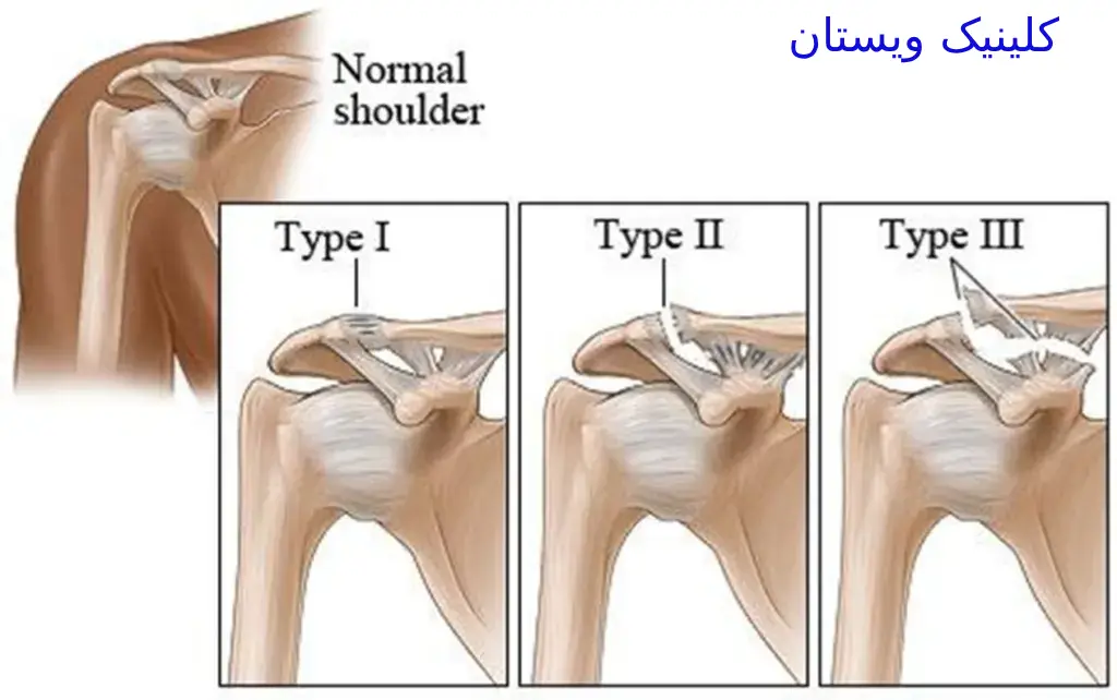 بررسیها نشان دادهاند که پی آر پی میتواند به بهبود عملکرد شانه کمک کند. پی آر پی یک روش غیرجراحی است و عوارض جانبی کمتری نسبت به جراحی دارد