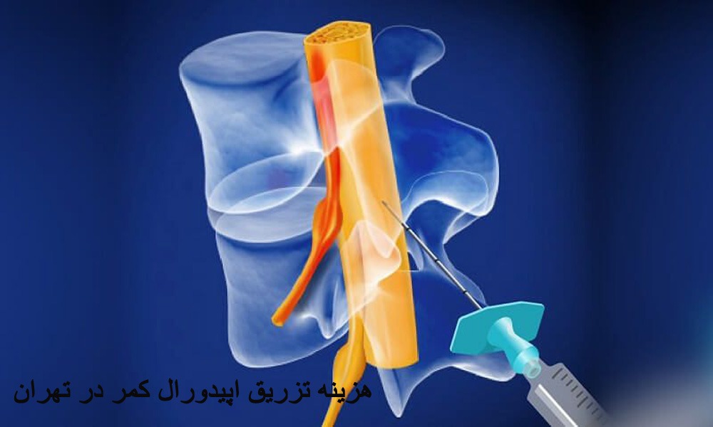 قیمت تزریق اپیدورال کمر چقدر است
