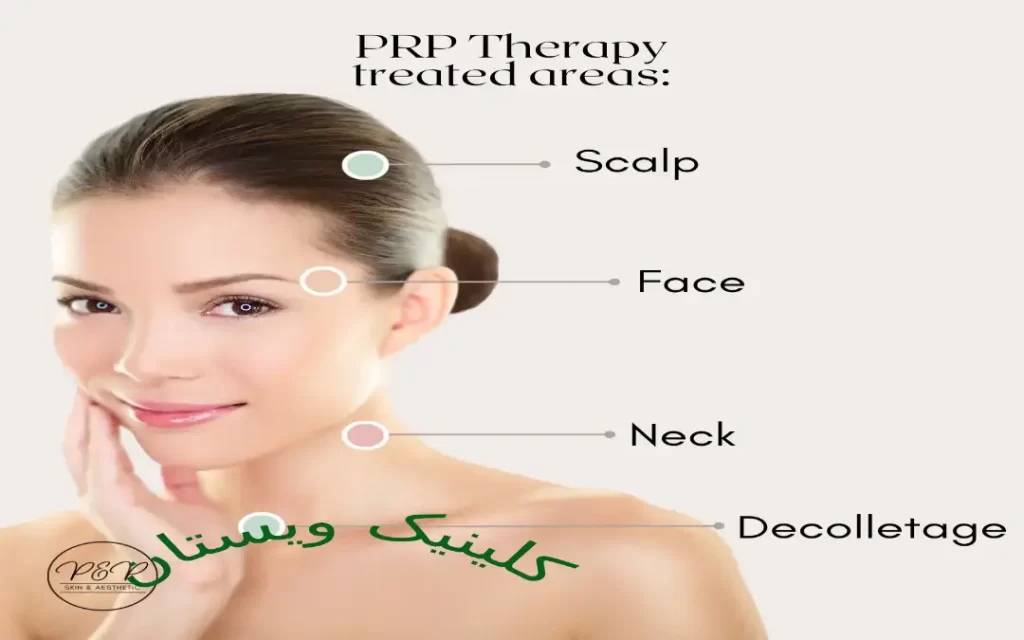 این روش باعث افزایش گردش خون در پوست میشود. PRP برای انواع مختلف پوست مناسب است.