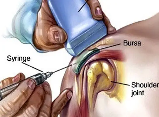 پی آر پی (Platelet-Rich Plasma) یک درمان نوین است این روش به بیمار امکان میدهد بدون جراحی بهبود یابد.