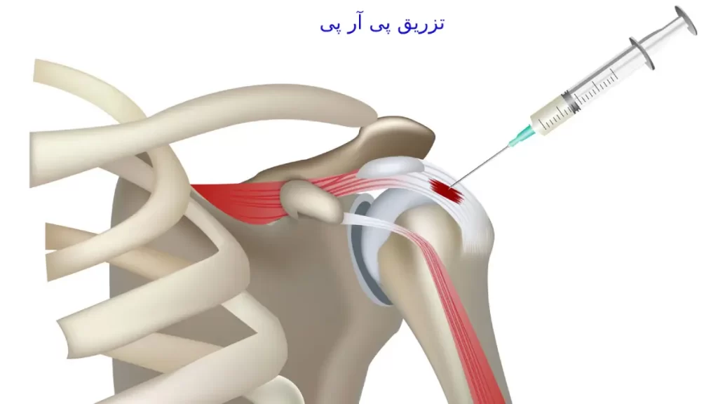 عموماً پی آر پی در کلینیک ویستان انجام میشود. پی آر پی میتواند در کاهش التهاب و درد مؤثر باشد.