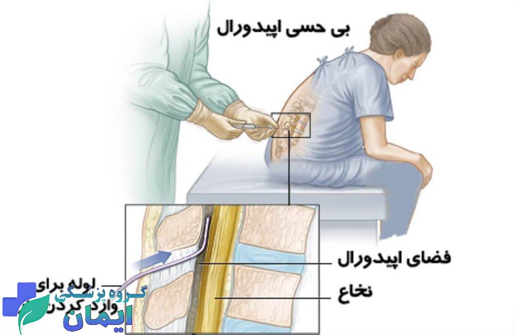 طریقه تزریق اپیدورال کمری طریقه تزریق اپیدورال کمری
