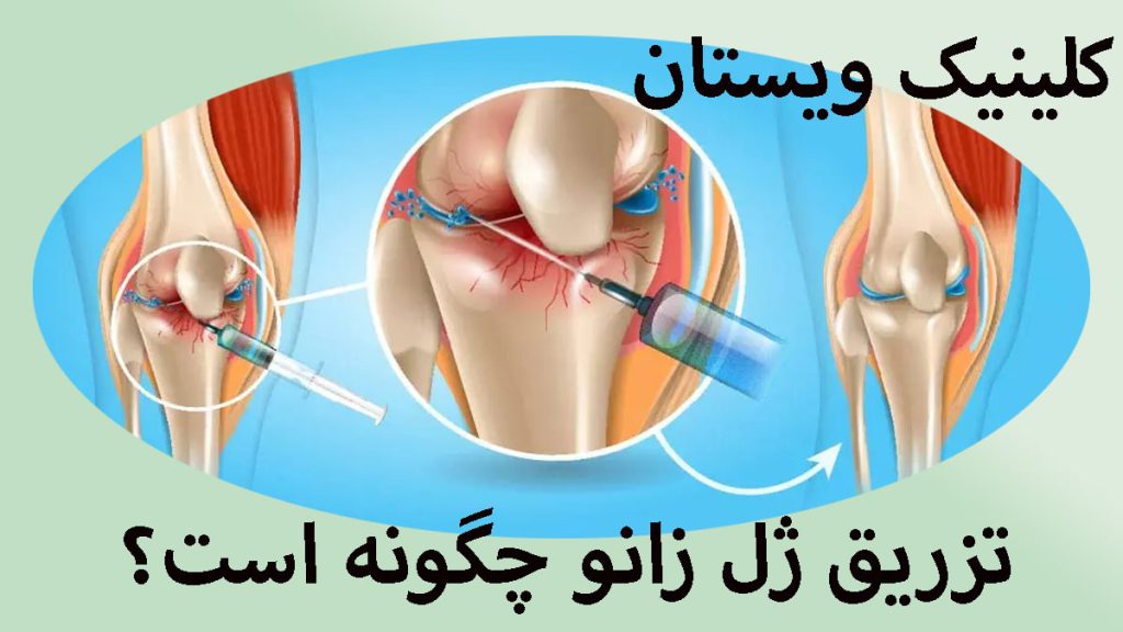 مراحل تزریق ژل به زانو