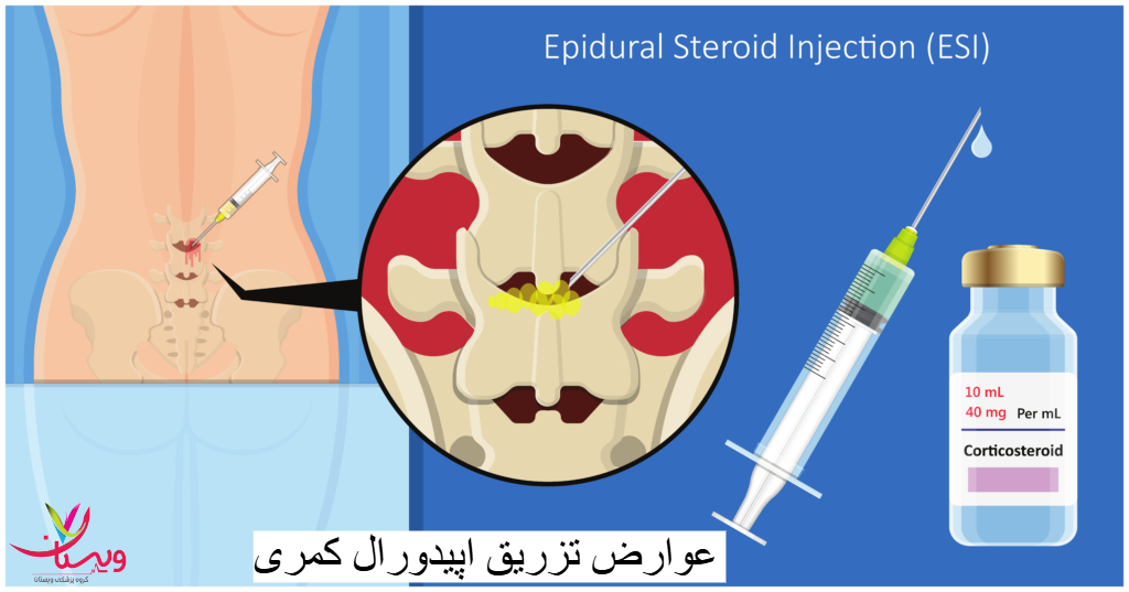 تزریق اپیورال کمری