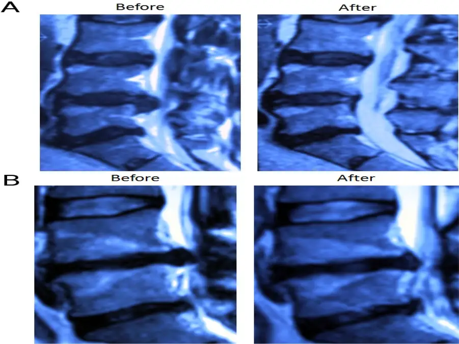 اوزون درمانی غیرجراحی است. تصویربرداری مانند MRI یا CT Scan برای تشخیص دقیقتر