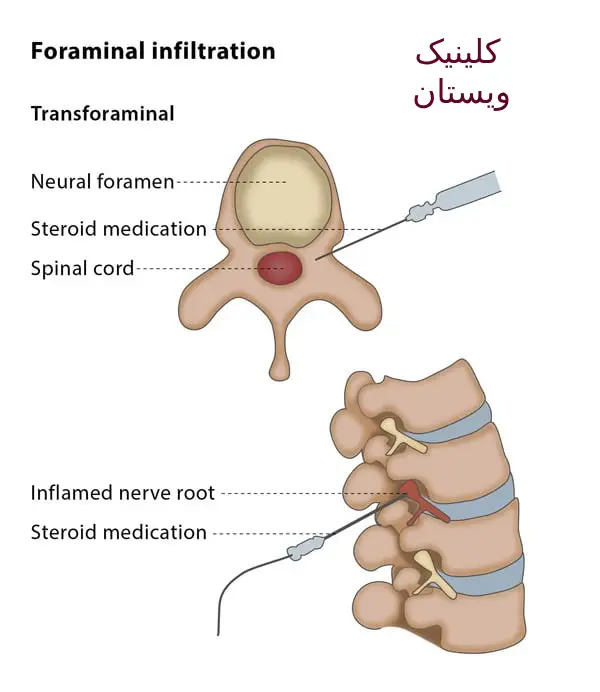 این روش در مطب پزشک انجام میشود. بیماران معمولاً سریعتر بهبود مییابند.