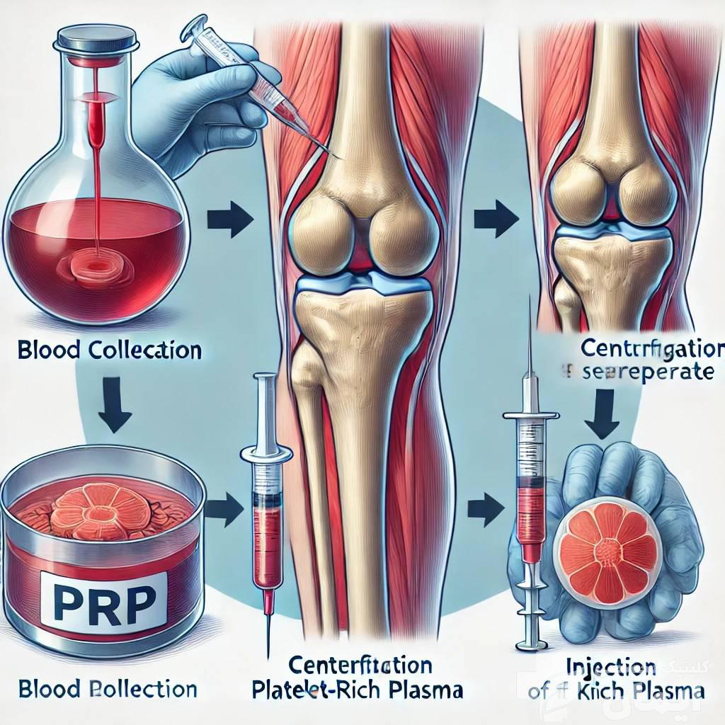 آماده سازی خون بیمار برای پی آر پی نمونه خون بیمار در حال آماده سازی برای استخراج پلاکت ها