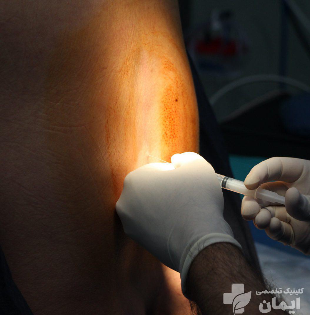 درمان اپیدورال بیماریهای قابل درمان با اپیدورال کمر