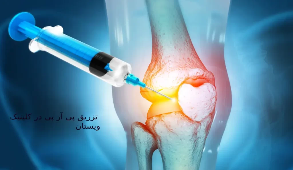 پی آر پی: فرآیند ساده و بدون عوارض جانبی جدی است. پی آر پی: برای درمان آسیبهای ورزشی و التهابهای مزمن مناسب است.