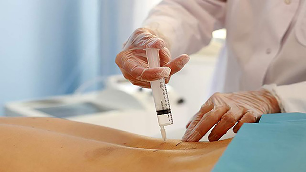 پزشکی که با گاز اوزون درمان دیسک کمر انجام می دهد