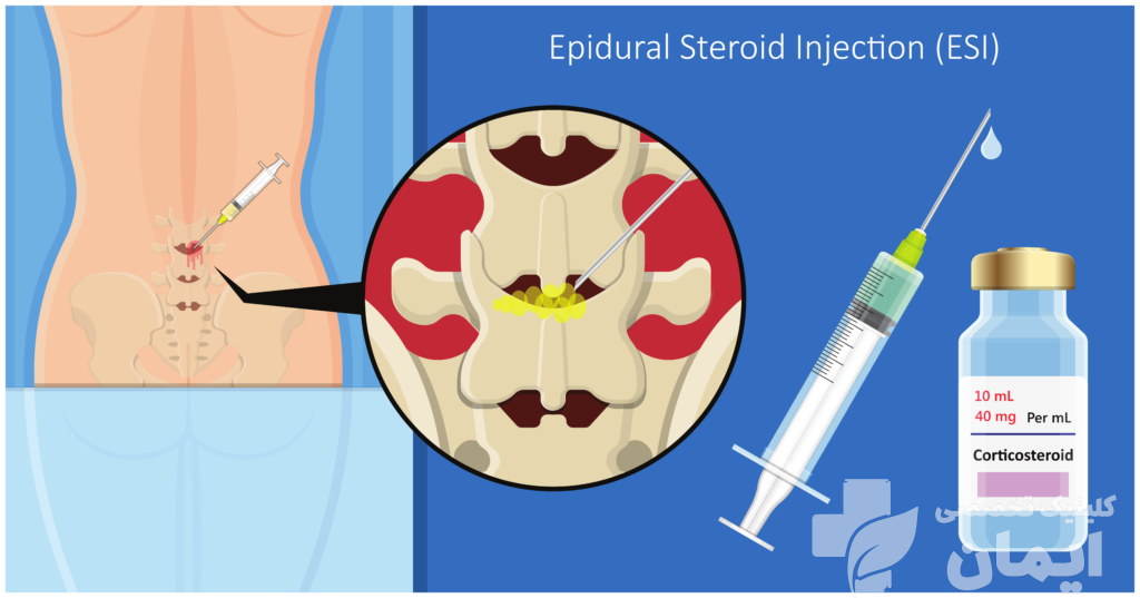 تزریق اپیدورال در تهران | معرفی 10کلینیک تخصصی برتر اپیدورال