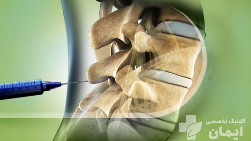 تزریق غضروف برای تسکین کمردرد نمایی از تزریق غضروف به ستون فقرات
