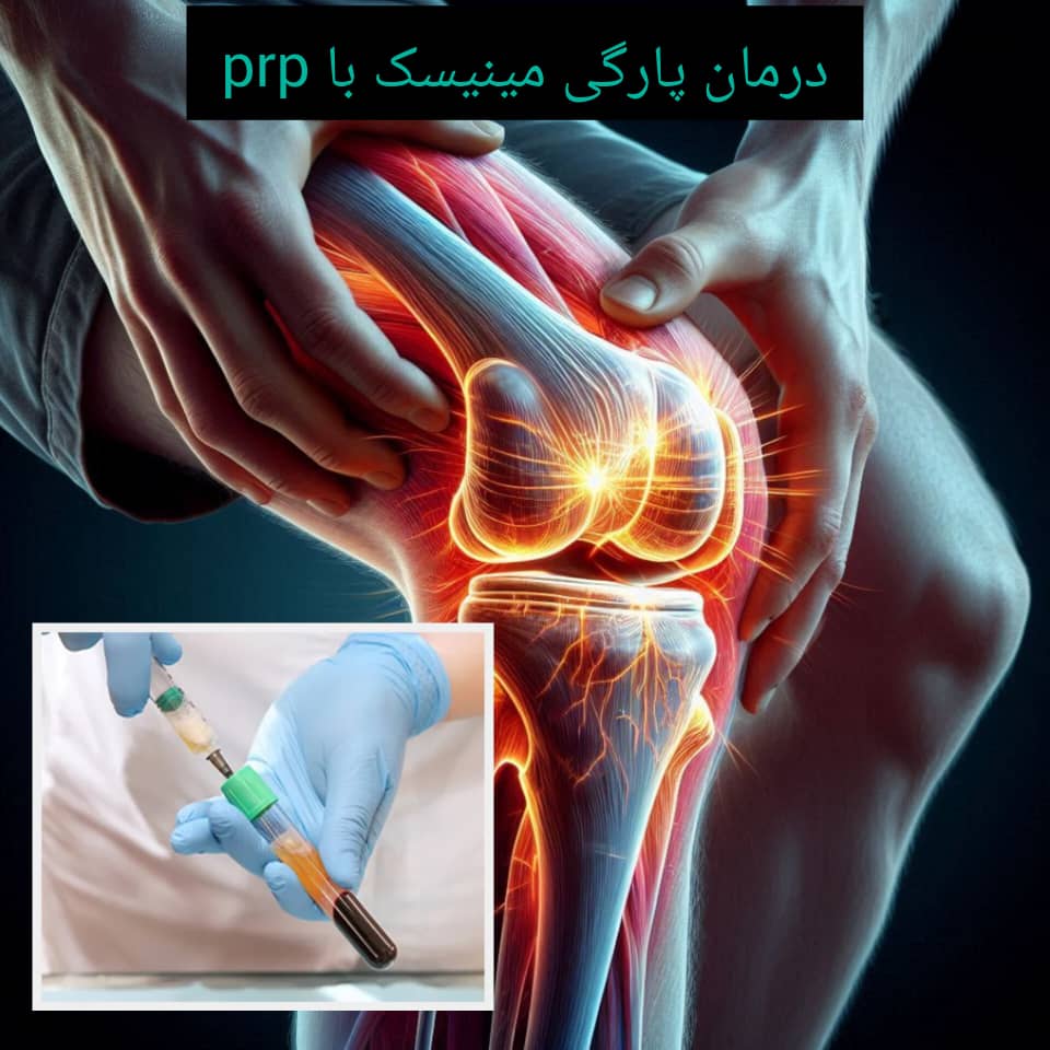 درمان پارگی مینیسک با پی آر پی درمان پارگی مینیسک با پی آر پی