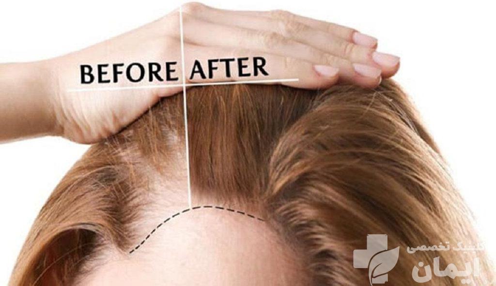 قبل و بعد استفاده از پی آر پی مو یک خانم قبل و بعد استفاده از پی آر پی مو یک خانم