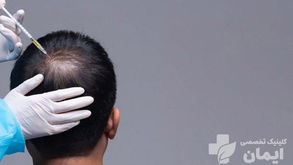 تزریق پی آر پی به پشت سر یک مرد تزریق پی آر پی به پشت سر یک مرد