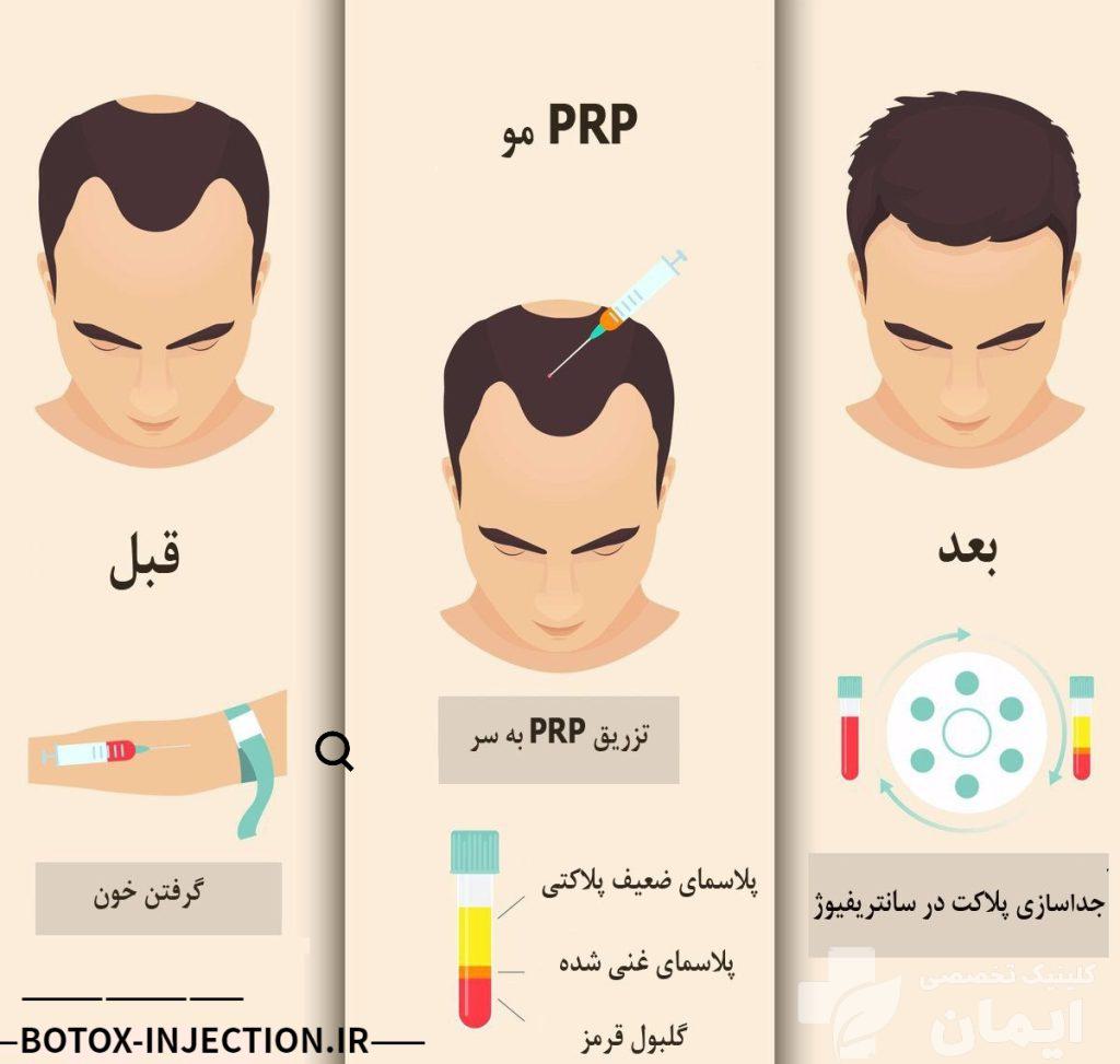 به تصویر کشیدن درمان ریزش مو