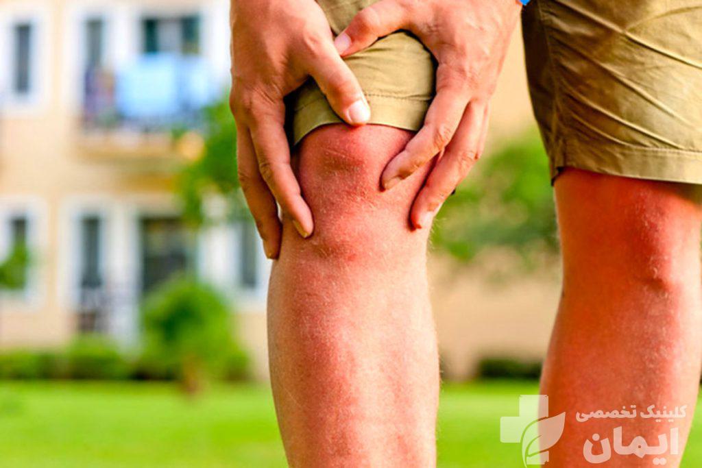 بیماری که دچار آرتروز زانو است بیماری که دچار آرتروز زانو است