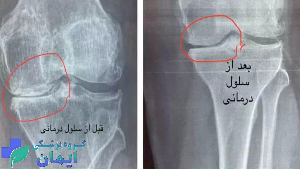 عکس قبل و بعد زانو تزریق سلول بنیادی به زانو