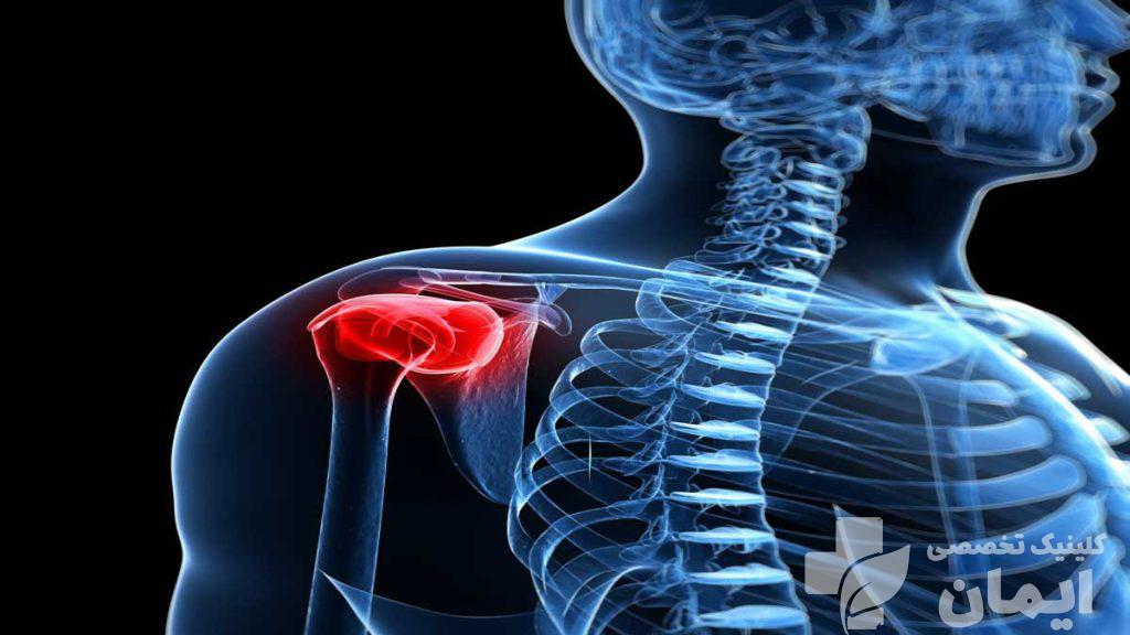 درمان شانه یخ زده