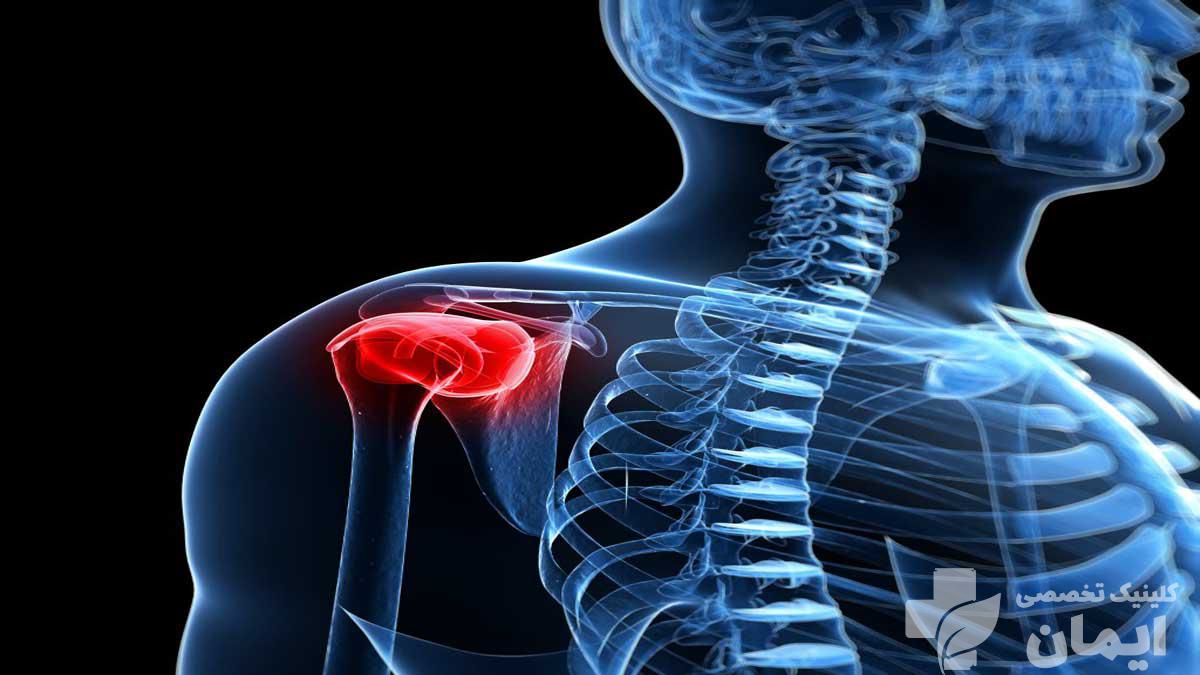 درمان شانه یخ زده