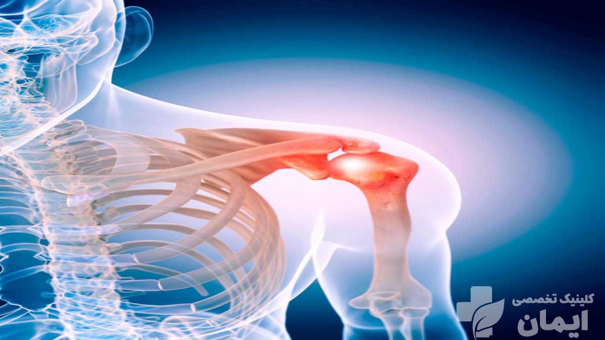 علت شانه یخزده چیست؟