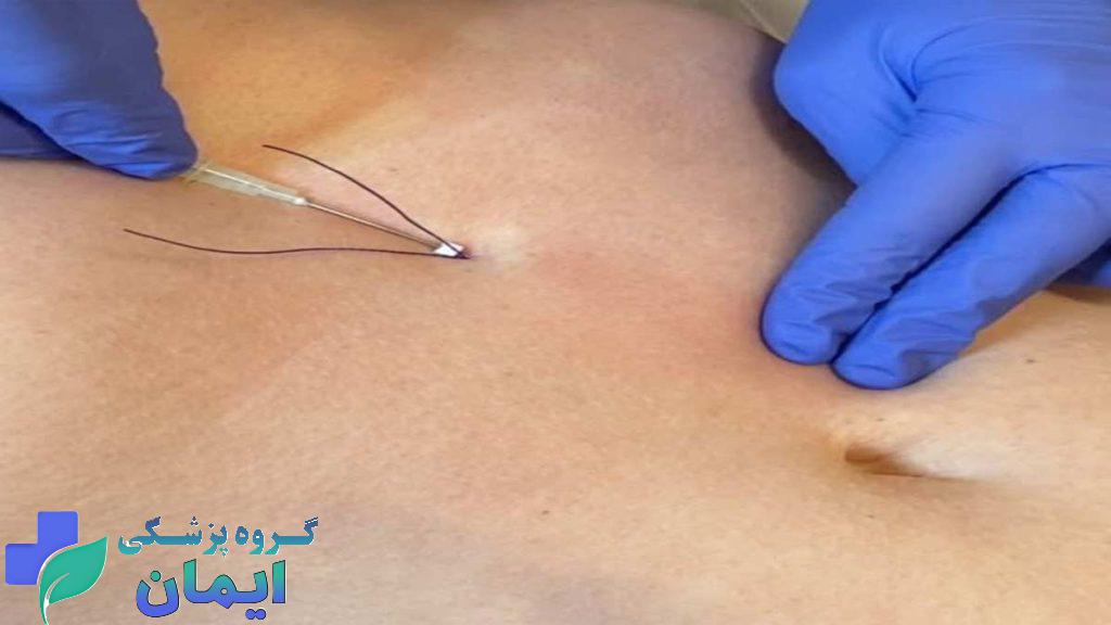 امبدینگ لاغری در کلینیک ویستان تحت نظر پزشکان با تجربه