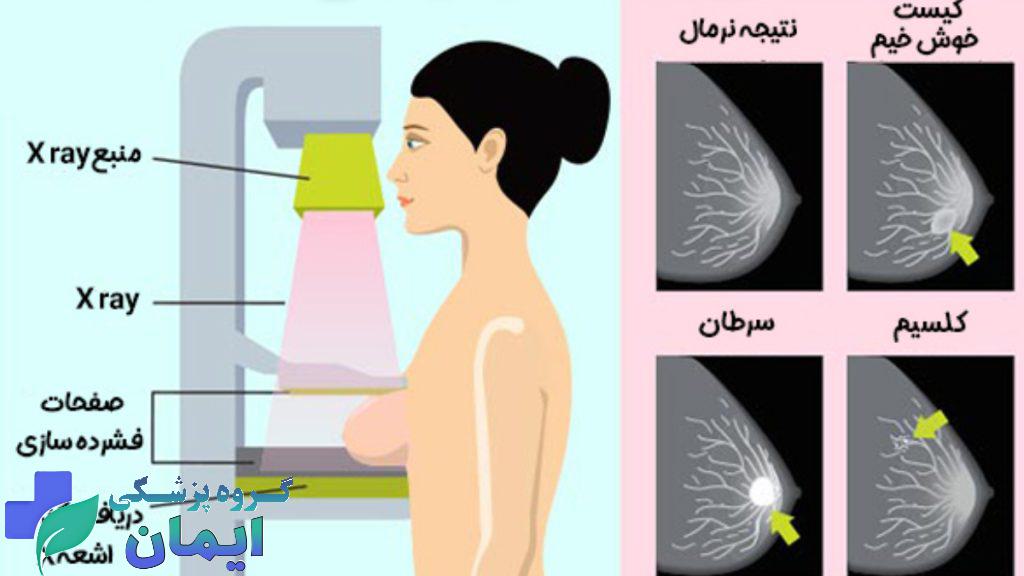 عکس پستان نرمال و بیمار توضیح مکانیسم دستگاه ماموگرافی دیجیتال برای اندازه گیری