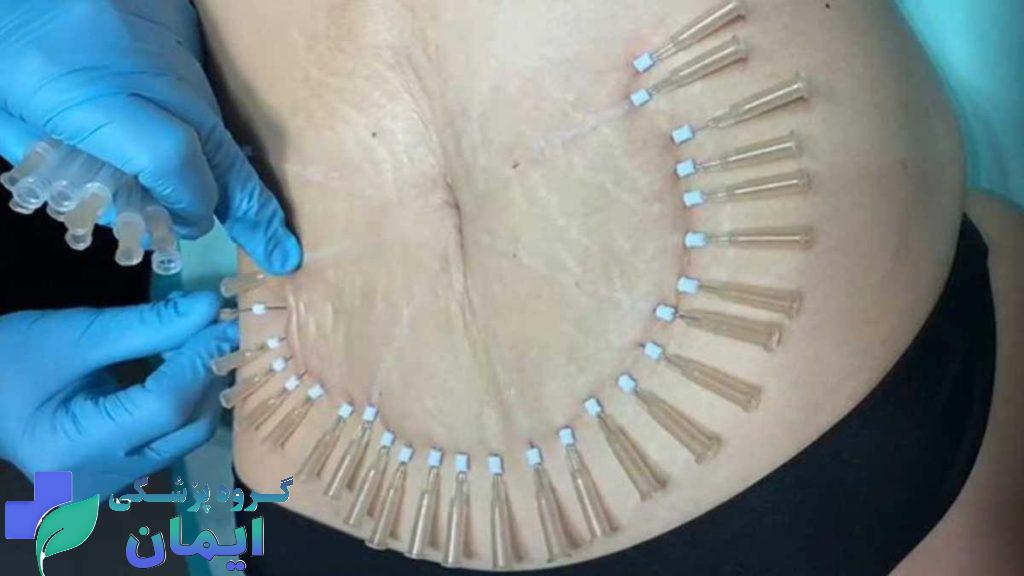 بیماری که به دلیل اضافه وزن امبدینگ لاغری میکند بیماری که به دلیل اضافه وزن امبدینگ لاغری میکند