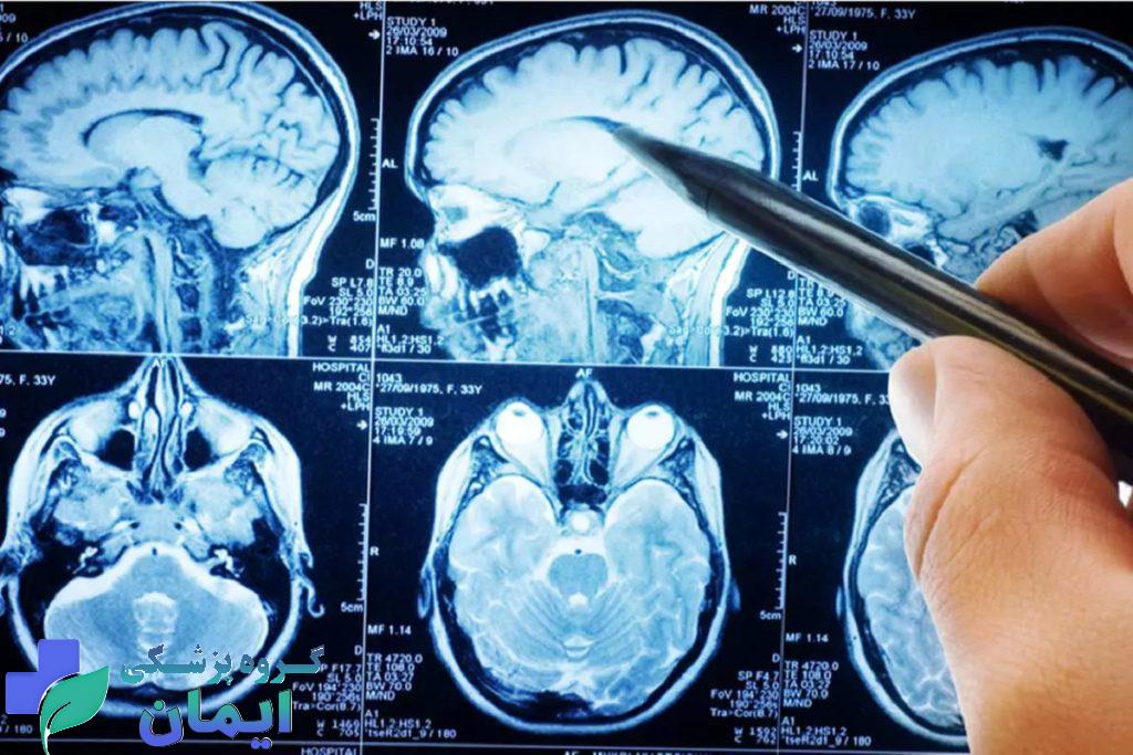 اسکن مغز و سکته مغزی اسکن مغز و سکته مغزی