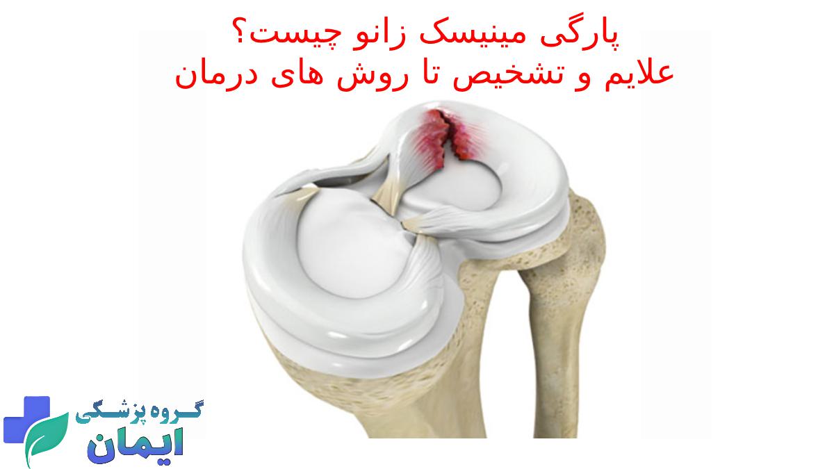 پارگی مینیسک زانو چیست بهترین قرص برای درمان پاره شدن مینیسک زانو