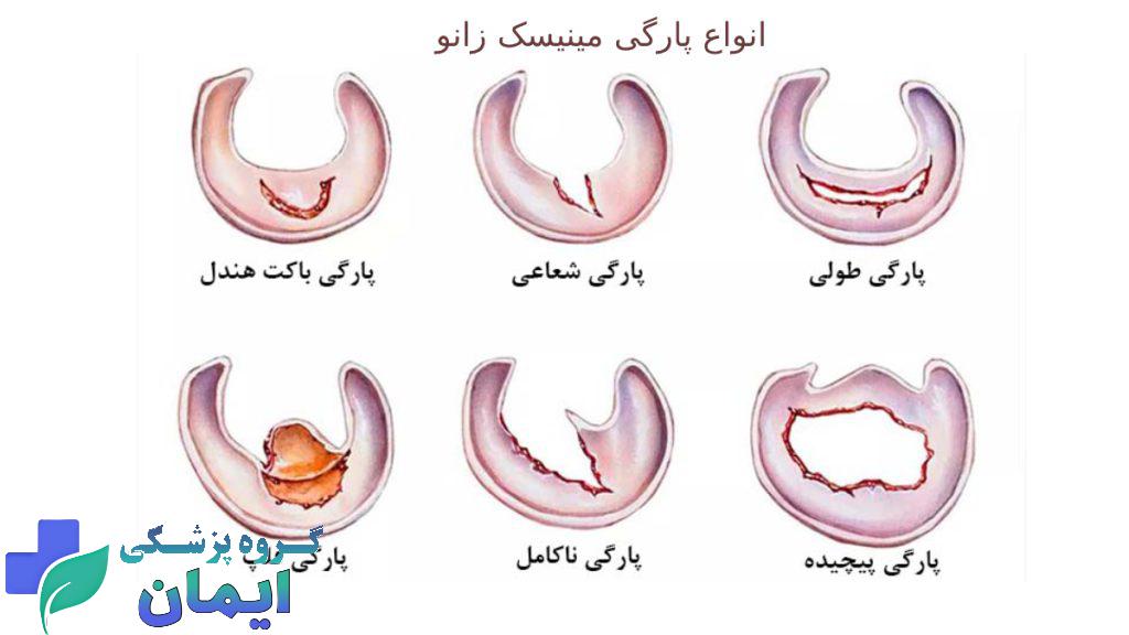 انواع پارگی مینیسک زانو