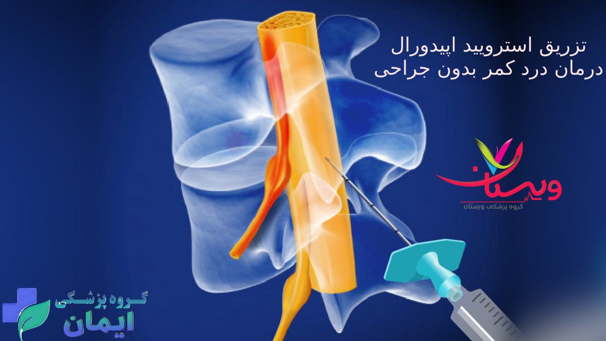 تزریق استروئید اپیدورال تزریق استروئید اپیدورال برای درمان درد کمر