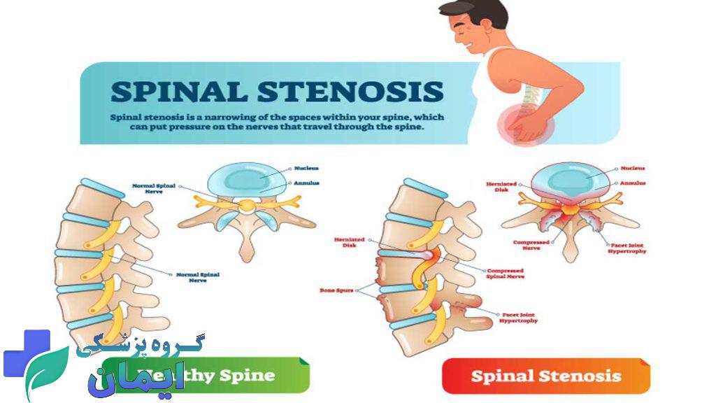 تنگی کانال نخاعی چیست؟