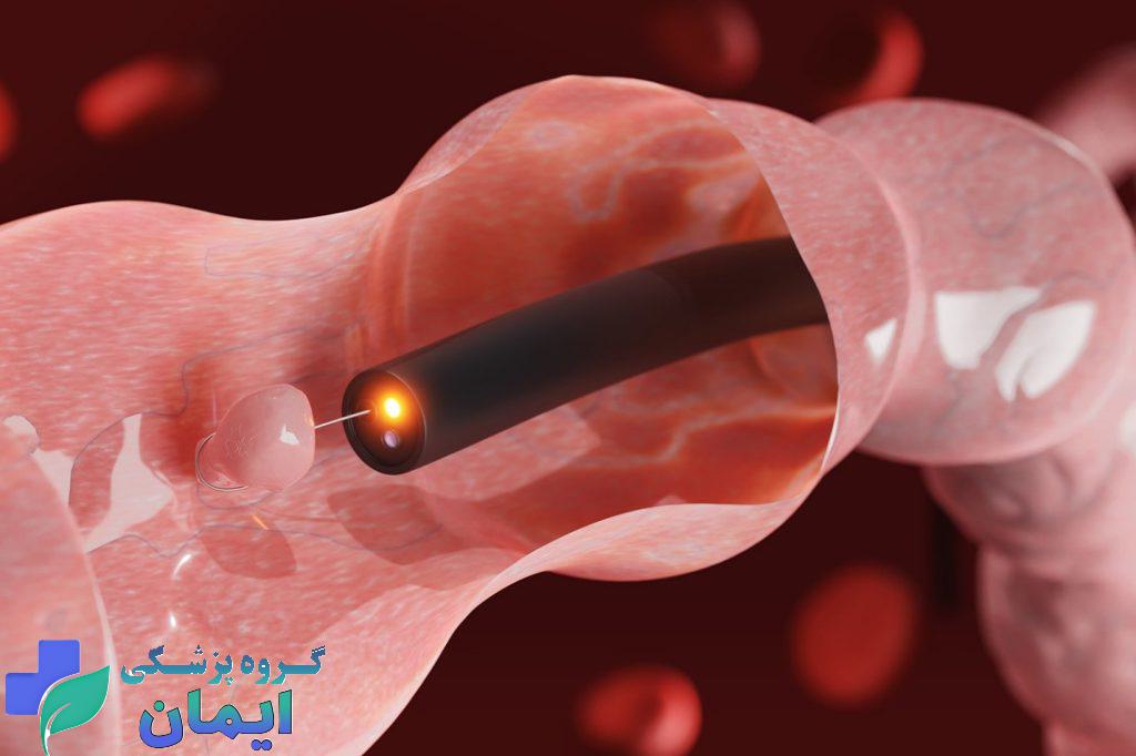 برداشتن پولیپ معده با آندوسکوپی برداشتن پولیپ معده با آندوسکوپی