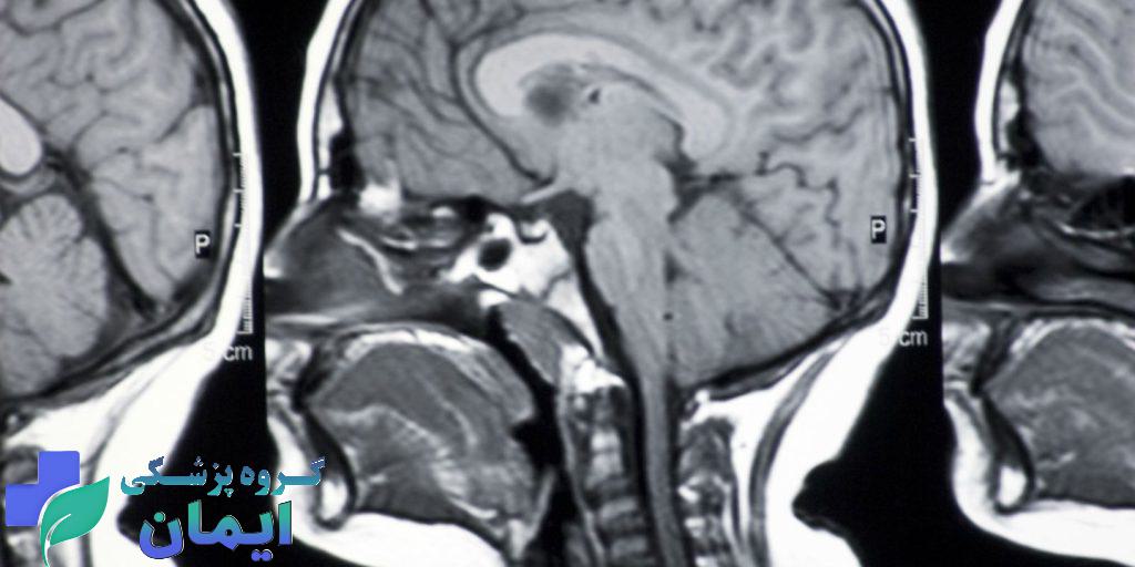 ام آر آی مغز بیماری که ام اس دارد ام آر آی مغز بیماری که ام اس دارد