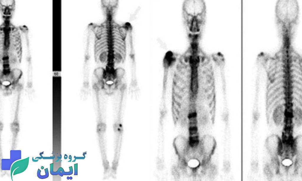 تصویر پت اسکن بیمار تصویر پت اسکن بیمار