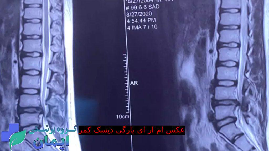 پارگی دیسک کمر تصویری از ام آر آی پارگی دیسک کمر - هزینه ام آر آی کمر چقدر است؟