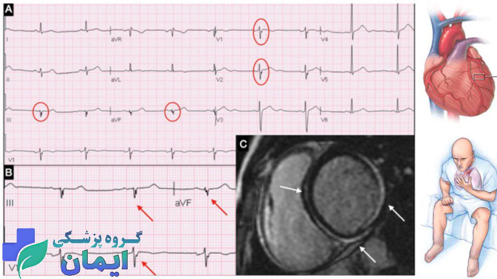 myocarditis ecg درمان میوکاردیت - نوار قلب در میوکاردیت چه شکلی می شود؟