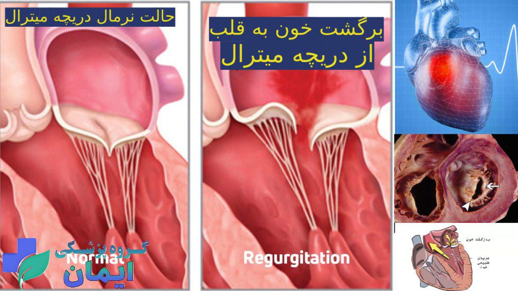 بازگشت خون به قلب خون پس دادن دریچه میترال قلب